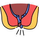 Fissure