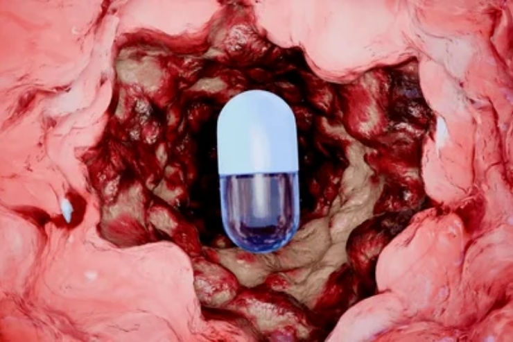 RECTAL POLYP------13