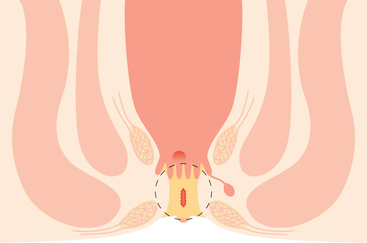 Anal-Stricture