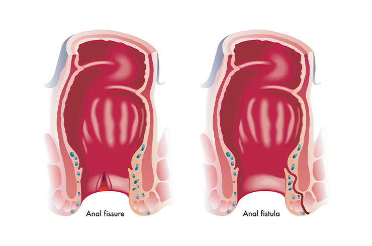 Fistula-in-Ano
