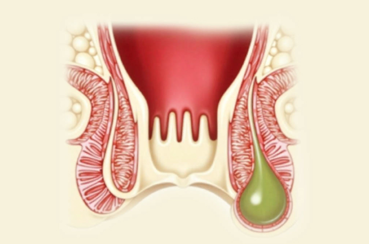 Perianal-Abscess