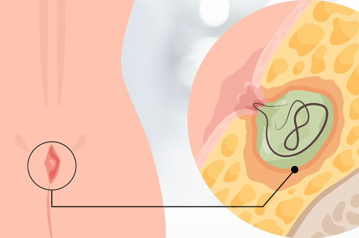 Pilonidal Sinus