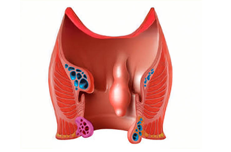 Rectal Polyp