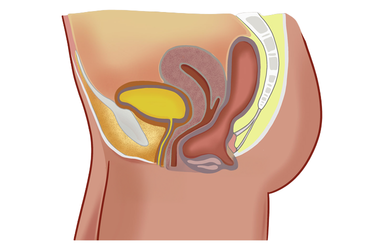 Rectocele